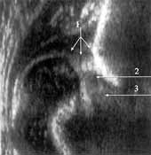 Ошибки при узи тазобедренных суставов